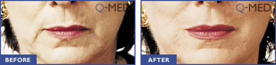 Restylane Before and After Image 3