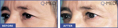 Botox Before and After Image 3