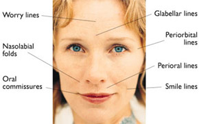 image showing restylane and perlane usage on wrinkles