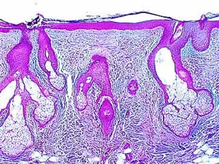 Cross section through skin sebaceous gland